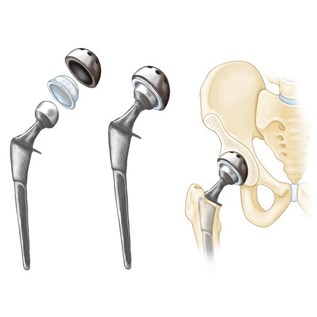 Hip Replacement Surgery in Tanda Hip Replacement Surgeon